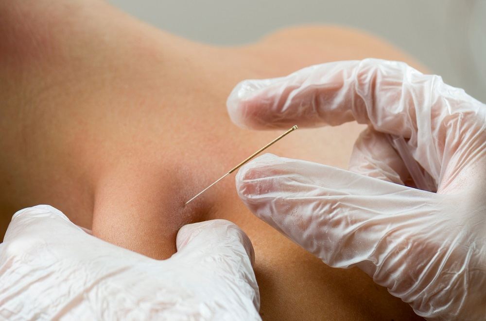 What is dry needling?