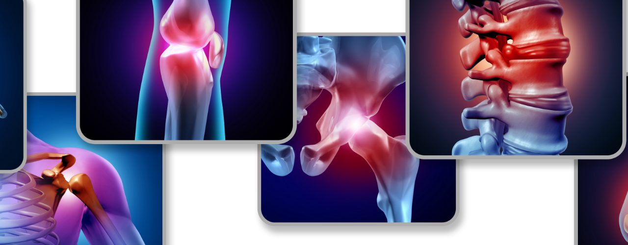 Arthritis