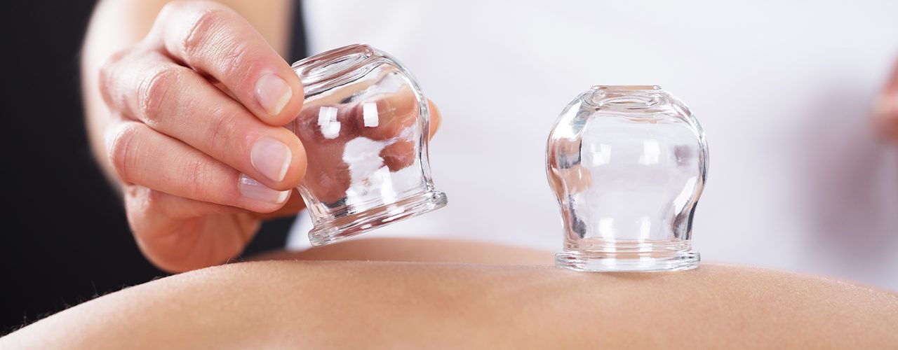 Cupping